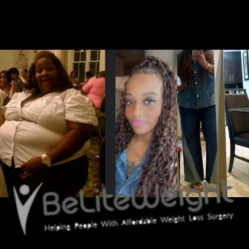 Weight Loss Surgery Gastric Sleeve before and after